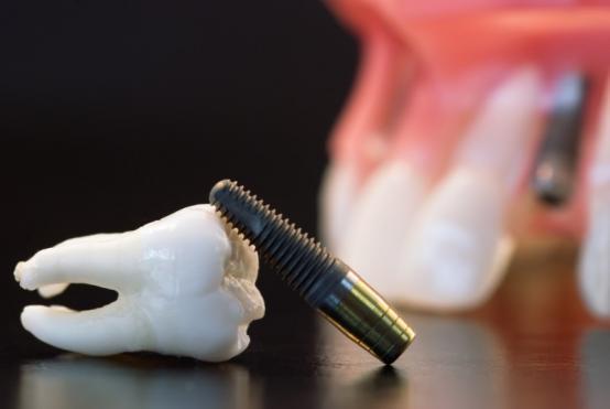 matériaux implant dentaire matériaux implant dentaire